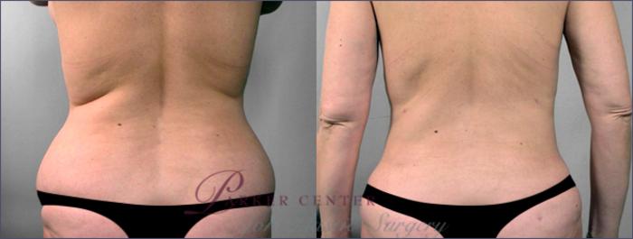 Liposuction Case 769 Before & After View #1 | Paramus, NJ | Parker Center for Plastic Surgery