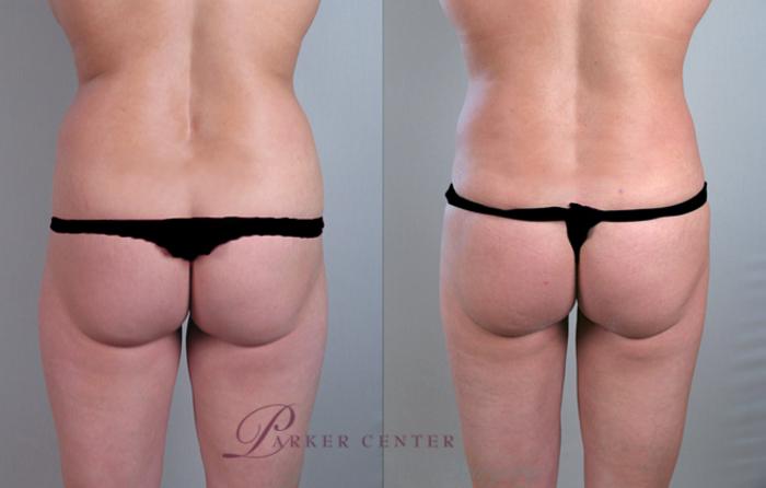 Liposuction Case 771 Before & After View #1 | Paramus, NJ | Parker Center for Plastic Surgery