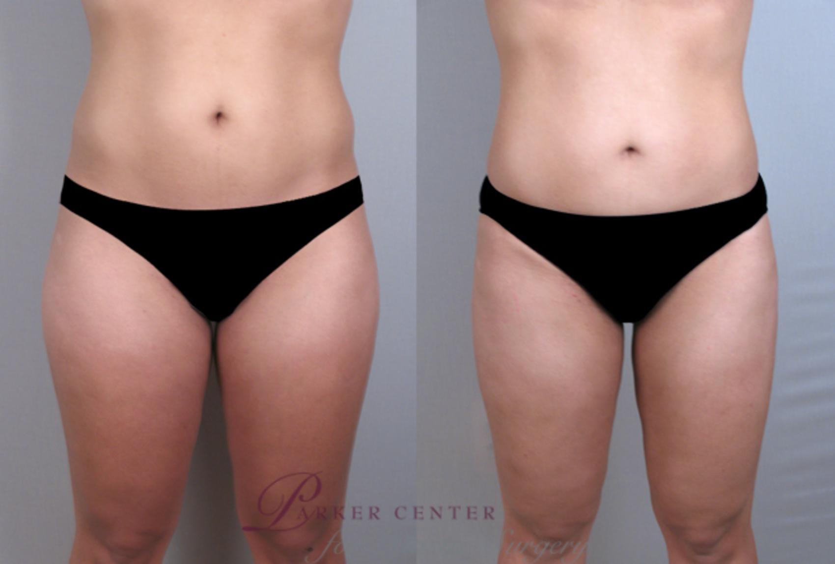 Liposuction Case 772 Before & After View #1 | Paramus, NJ | Parker Center for Plastic Surgery