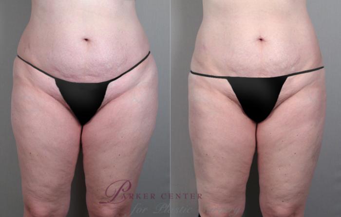 Liposuction Case 773 Before & After View #1 | Paramus, NJ | Parker Center for Plastic Surgery