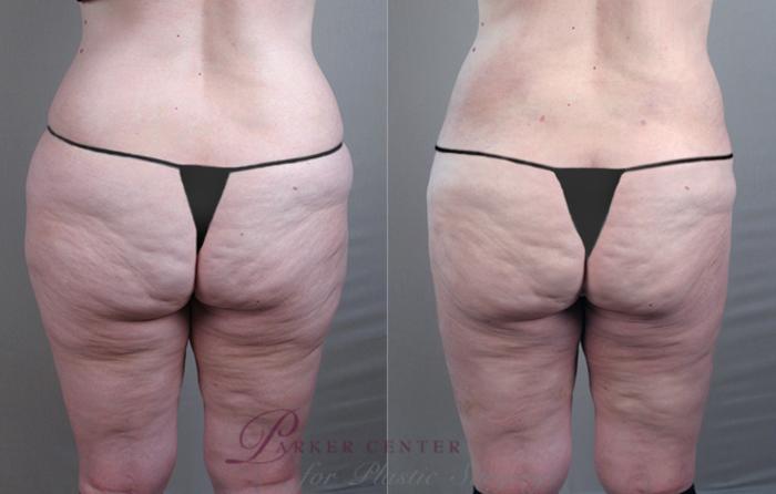 Liposuction Case 773 Before & After View #2 | Paramus, NJ | Parker Center for Plastic Surgery