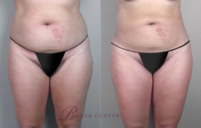 Liposuction Case 774 Before & After View #1 | Paramus, NJ | Parker Center for Plastic Surgery