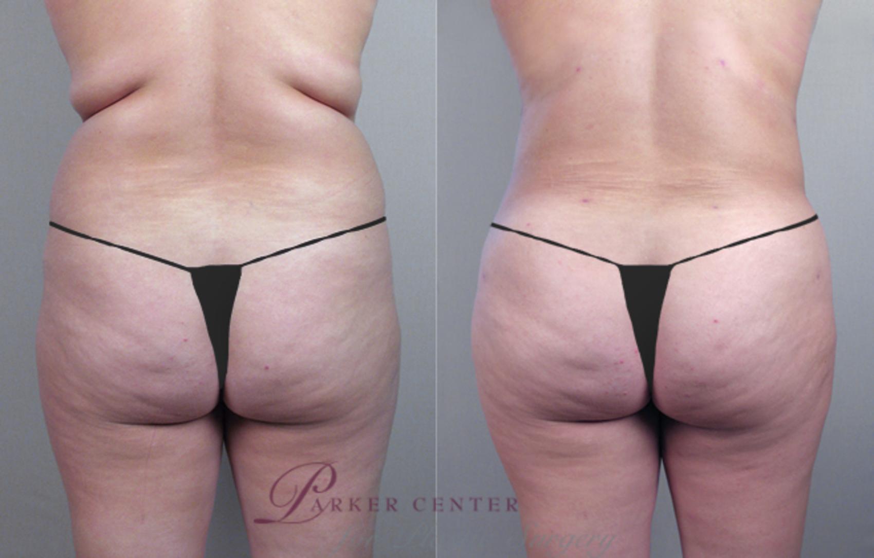 Liposuction Case 774 Before & After View #2 | Paramus, NJ | Parker Center for Plastic Surgery