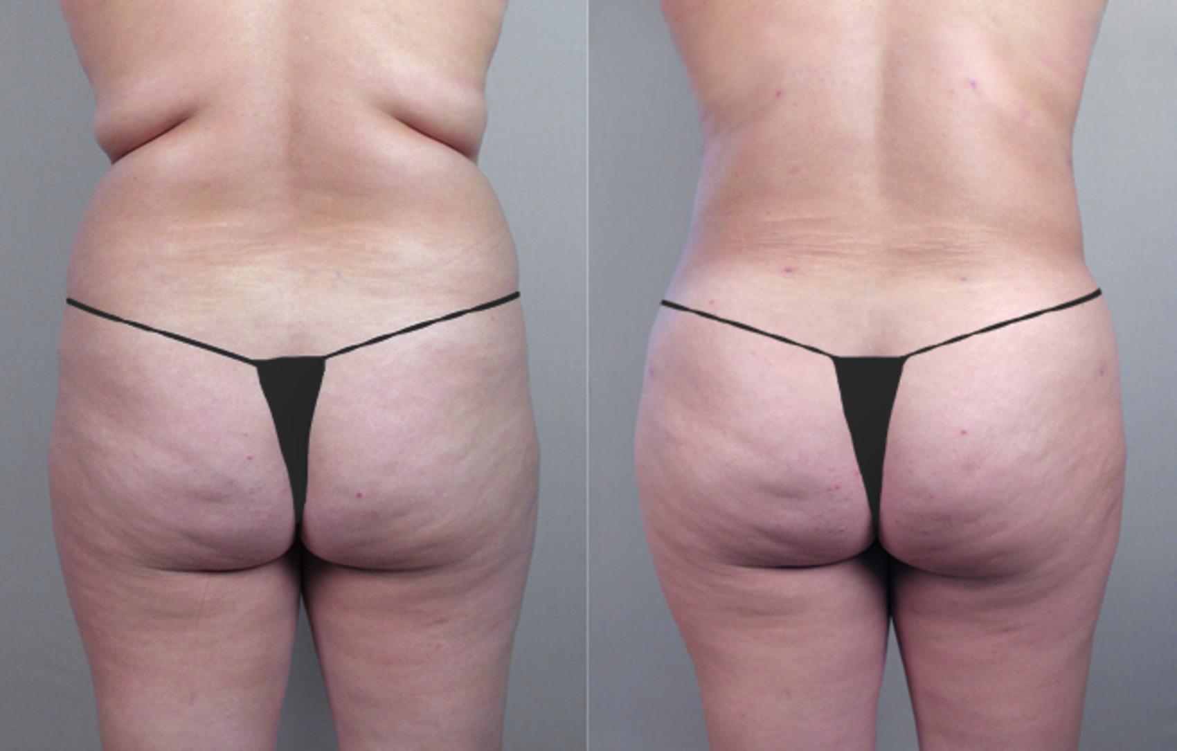 Liposuction Case 774 Before & After View #2 | Paramus, NJ | Parker Center for Plastic Surgery