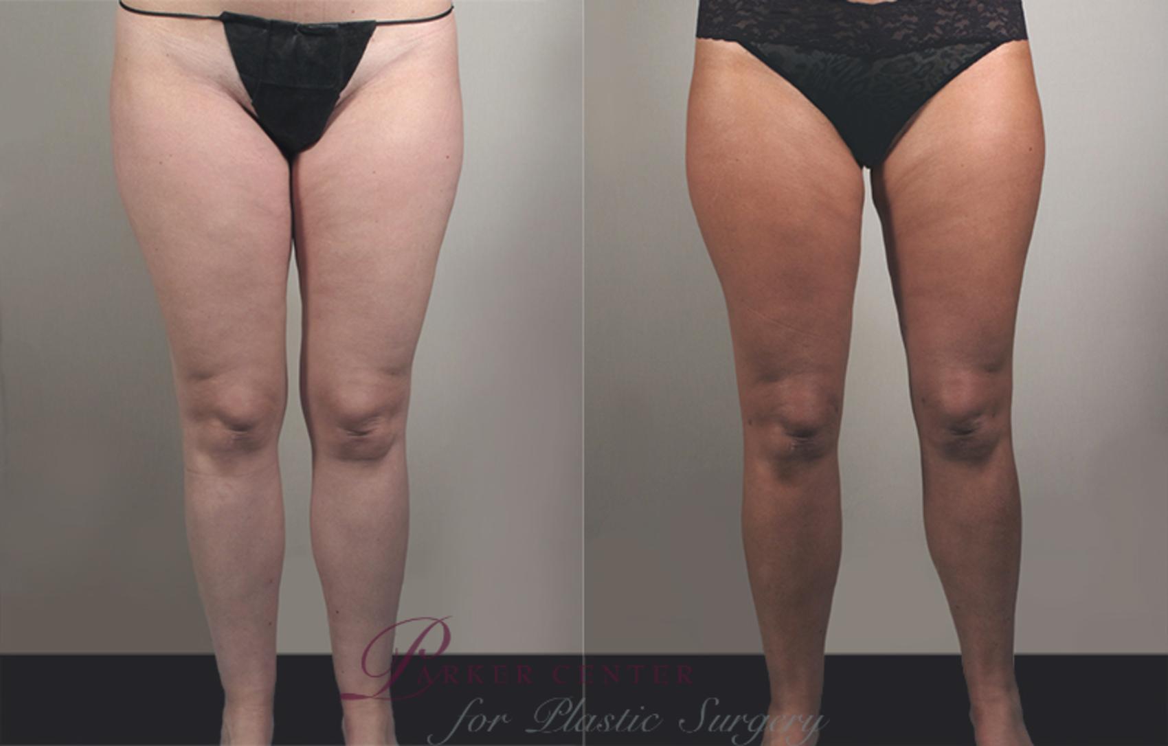 Liposuction Case 777 Before & After View #1 | Paramus, NJ | Parker Center for Plastic Surgery