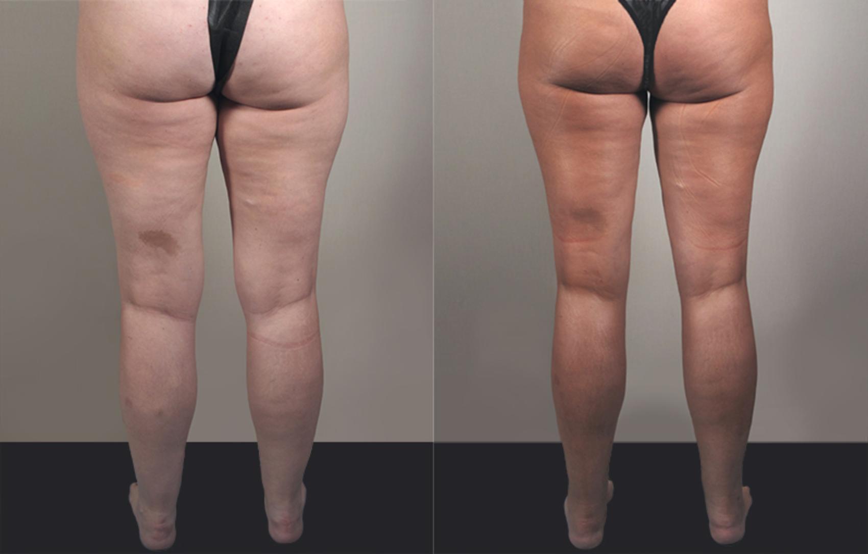 Liposuction Case 777 Before & After View #2 | Paramus, New Jersey | Parker Center for Plastic Surgery