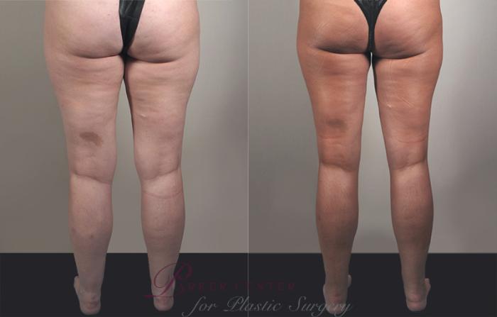 Liposuction Case 777 Before & After View #2 | Paramus, NJ | Parker Center for Plastic Surgery