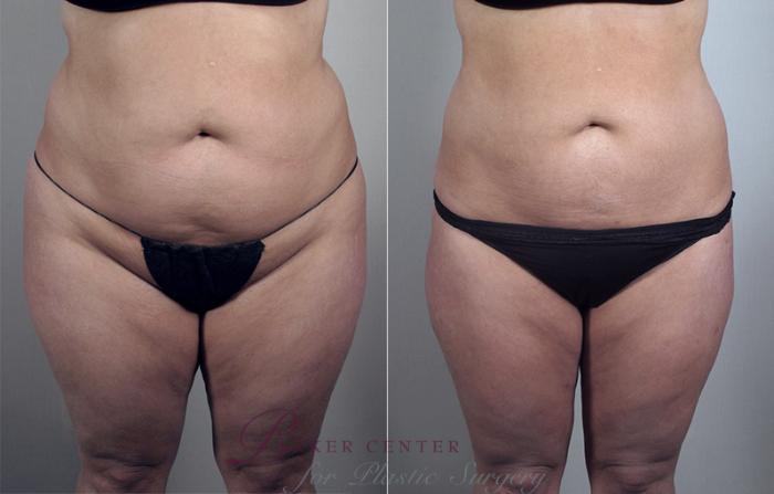 Liposuction Case 778 Before & After View #1 | Paramus, NJ | Parker Center for Plastic Surgery