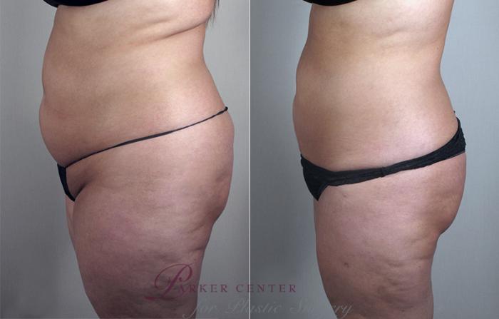 Liposuction Case 778 Before & After View #2 | Paramus, NJ | Parker Center for Plastic Surgery
