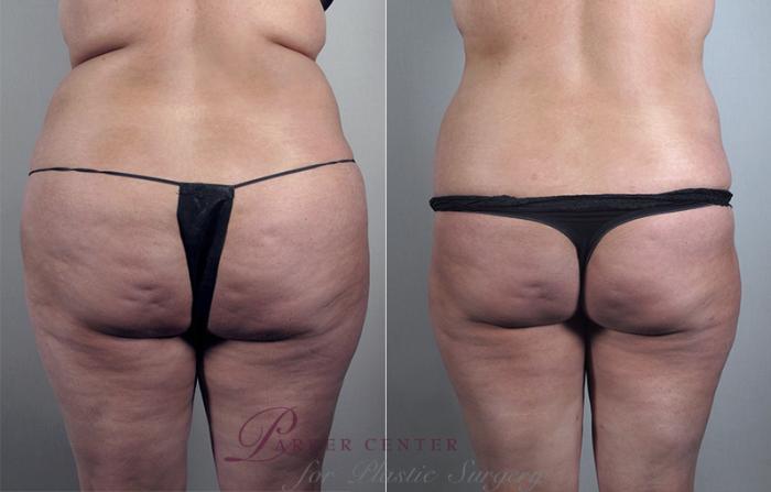 Liposuction Case 778 Before & After View #3 | Paramus, NJ | Parker Center for Plastic Surgery