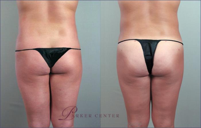 Liposuction Case 779 Before & After View #2 | Paramus, NJ | Parker Center for Plastic Surgery