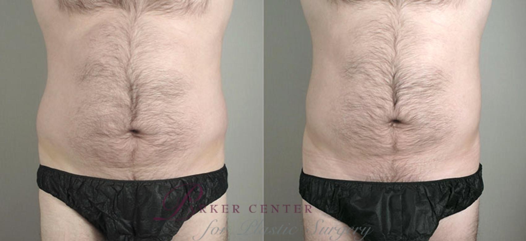 Liposuction Case 780 Before & After View #1 | Paramus, NJ | Parker Center for Plastic Surgery