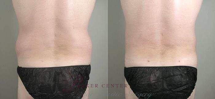 Liposuction Case 780 Before & After View #2 | Paramus, NJ | Parker Center for Plastic Surgery