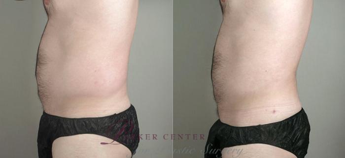 Liposuction Case 780 Before & After View #3 | Paramus, NJ | Parker Center for Plastic Surgery
