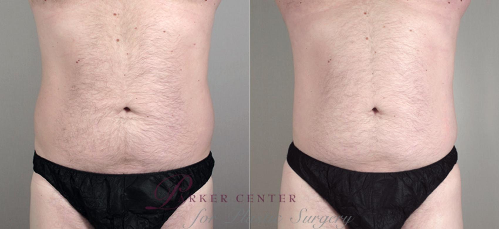 Liposuction Case 781 Before & After View #1 | Paramus, NJ | Parker Center for Plastic Surgery