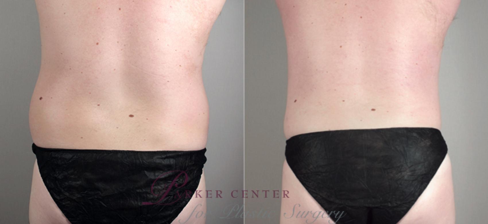 Liposuction Case 781 Before & After View #2 | Paramus, NJ | Parker Center for Plastic Surgery