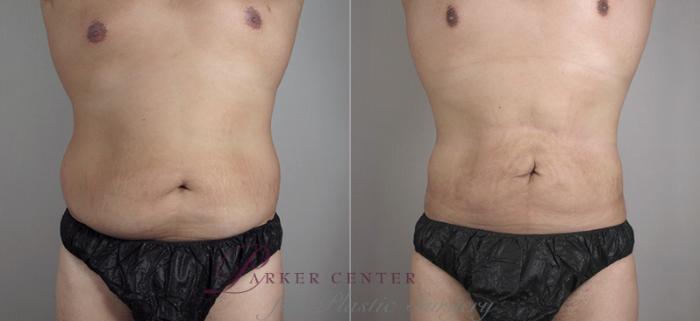 Liposuction Case 782 Before & After View #1 | Paramus, NJ | Parker Center for Plastic Surgery