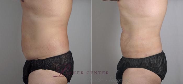Liposuction Case 782 Before & After View #2 | Paramus, NJ | Parker Center for Plastic Surgery