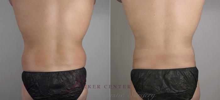 Liposuction Case 782 Before & After View #3 | Paramus, NJ | Parker Center for Plastic Surgery