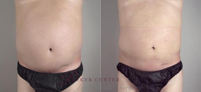 Liposuction Case 783 Before & After View #1 | Paramus, NJ | Parker Center for Plastic Surgery
