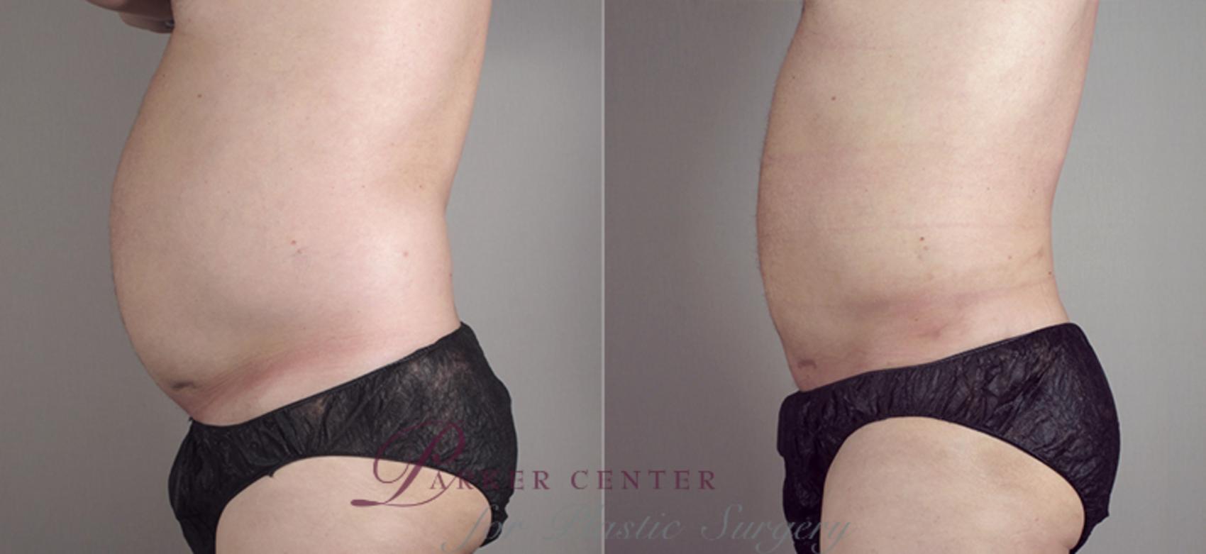 Liposuction Case 783 Before & After View #2 | Paramus, NJ | Parker Center for Plastic Surgery