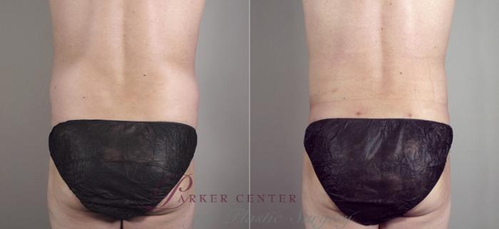 Liposuction Case 783 Before & After View #3 | Paramus, NJ | Parker Center for Plastic Surgery