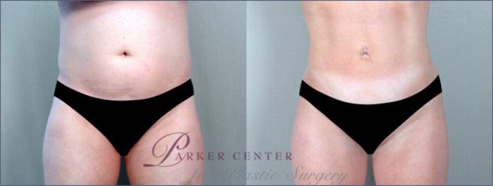 Liposuction Case 785 Before & After View #1 | Paramus, NJ | Parker Center for Plastic Surgery