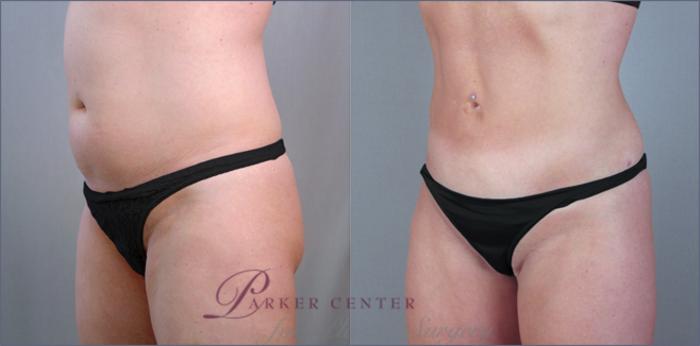 Liposuction Case 785 Before & After View #2 | Paramus, NJ | Parker Center for Plastic Surgery