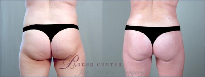 Liposuction Case 785 Before & After View #4 | Paramus, NJ | Parker Center for Plastic Surgery