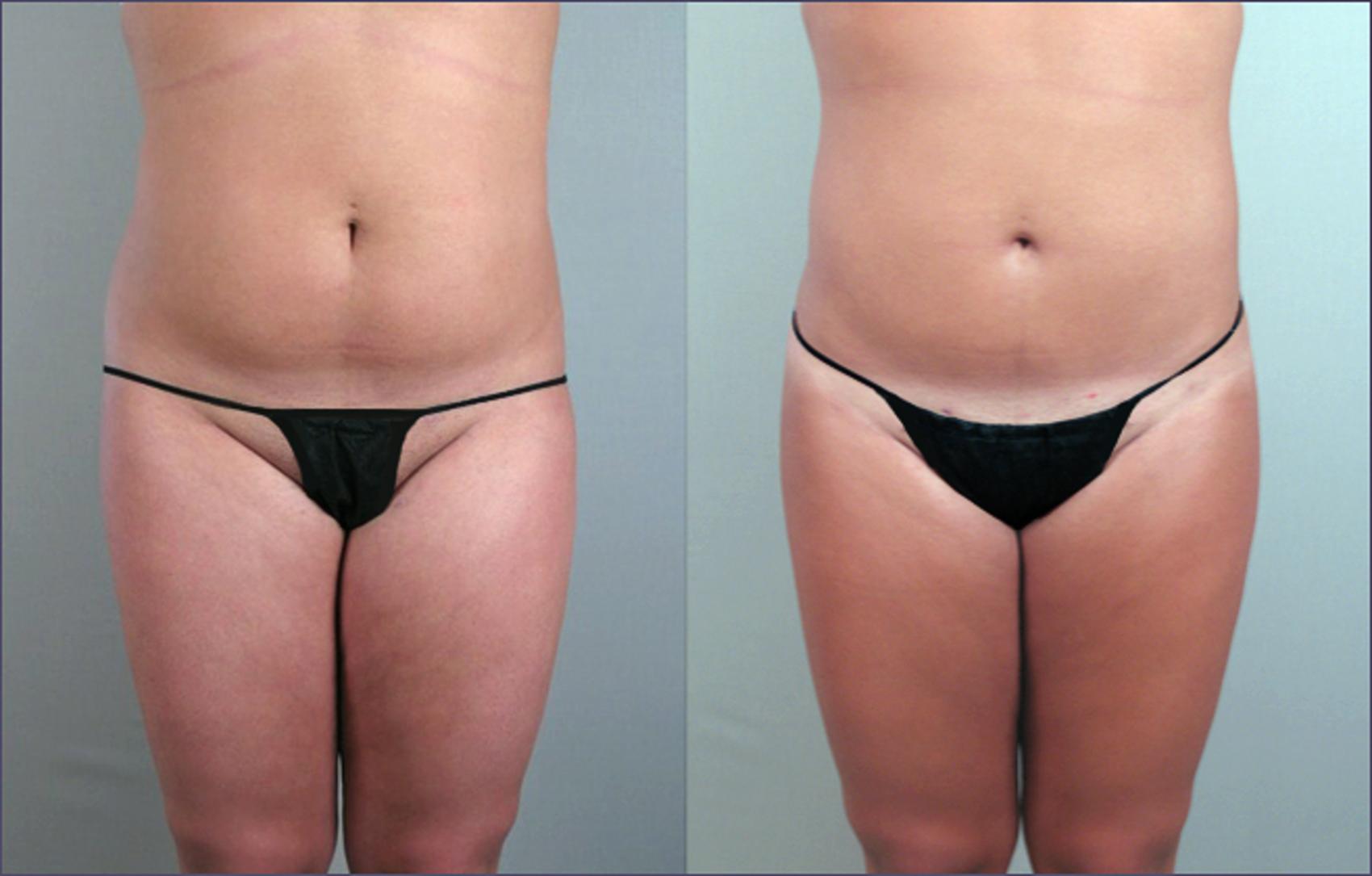 Liposuction Case 786 Before & After View #1 | Paramus, NJ | Parker Center for Plastic Surgery