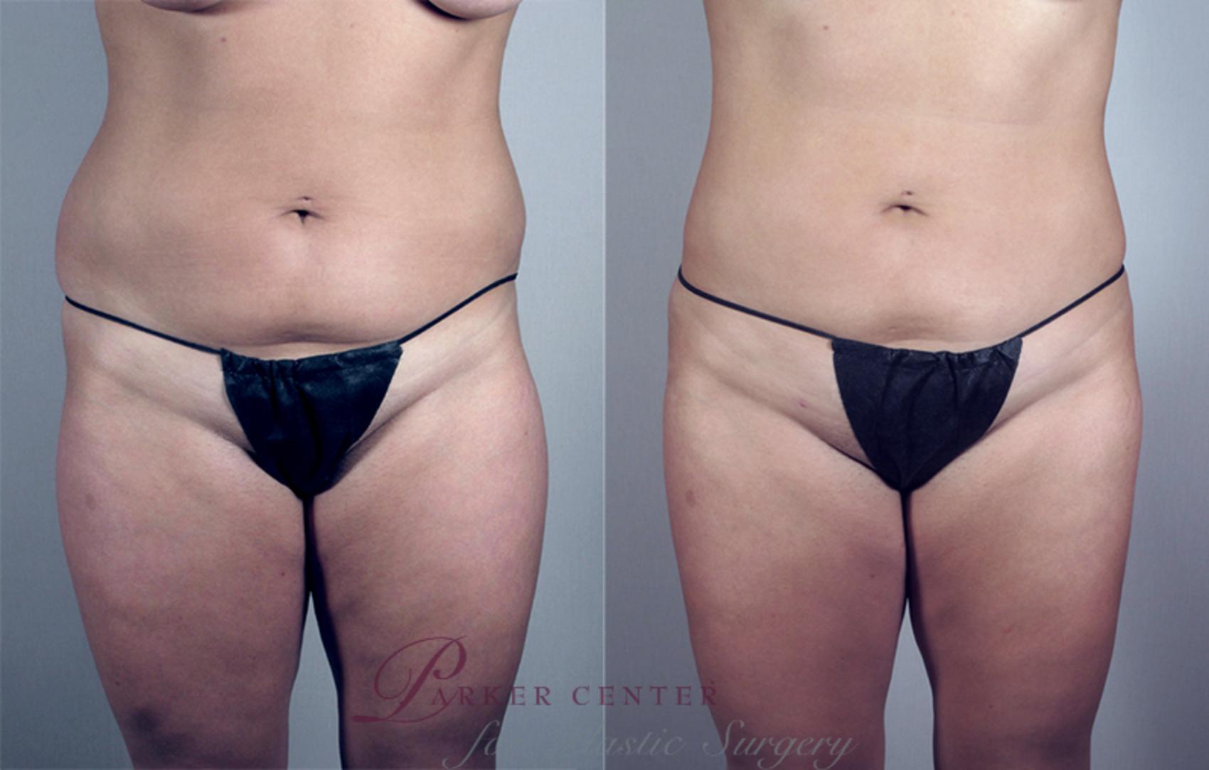 Liposuction Case 788 Before & After View #1 | Paramus, NJ | Parker Center for Plastic Surgery