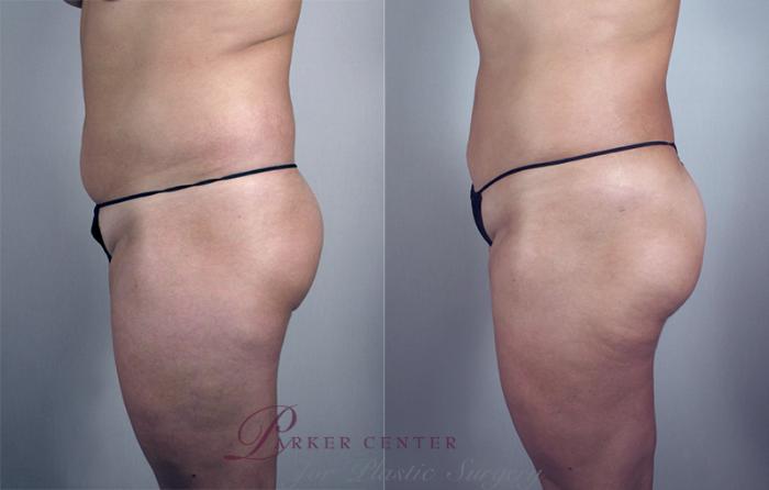 Liposuction Case 788 Before & After View #2 | Paramus, NJ | Parker Center for Plastic Surgery