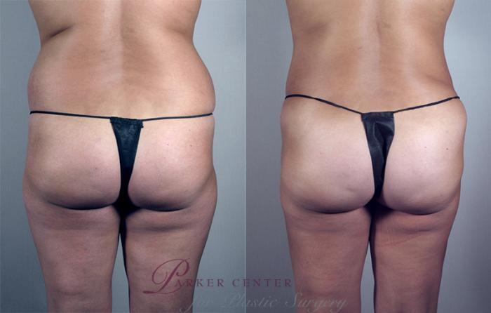Liposuction Case 788 Before & After View #3 | Paramus, NJ | Parker Center for Plastic Surgery