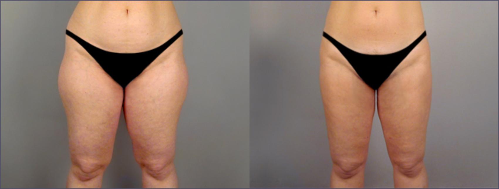 Liposuction Case 789 Before & After View #1 | Paramus, NJ | Parker Center for Plastic Surgery