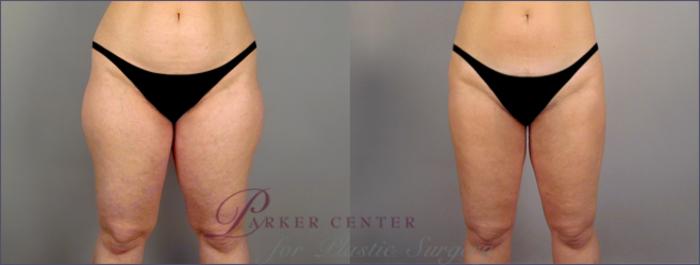 Liposuction Case 789 Before & After View #1 | Paramus, NJ | Parker Center for Plastic Surgery