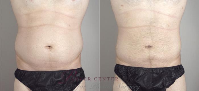 Liposuction Case 790 Before & After View #1 | Paramus, NJ | Parker Center for Plastic Surgery