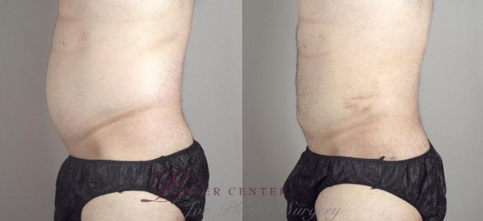 Liposuction Case 790 Before & After View #2 | Paramus, NJ | Parker Center for Plastic Surgery