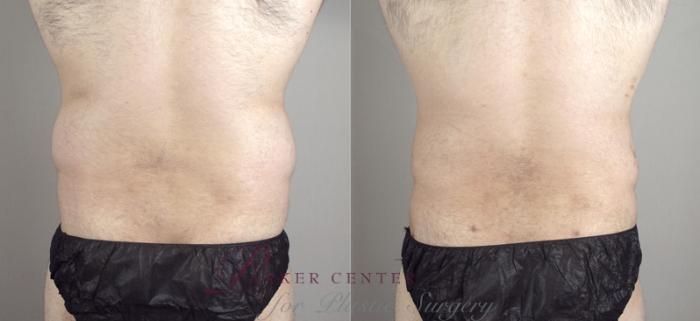 Liposuction Case 790 Before & After View #3 | Paramus, NJ | Parker Center for Plastic Surgery