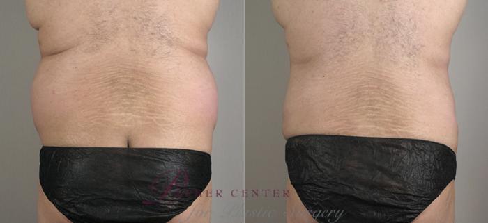 Liposuction Case 792 Before & After View #1 | Paramus, NJ | Parker Center for Plastic Surgery