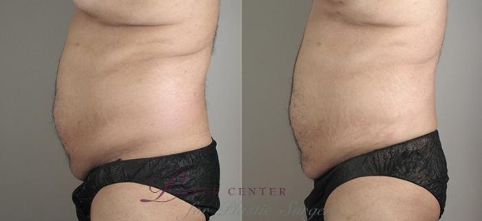 Liposuction Case 792 Before & After View #2 | Paramus, NJ | Parker Center for Plastic Surgery