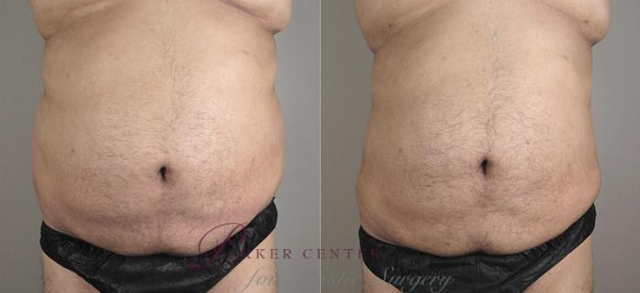 Liposuction Case 792 Before & After View #3 | Paramus, NJ | Parker Center for Plastic Surgery