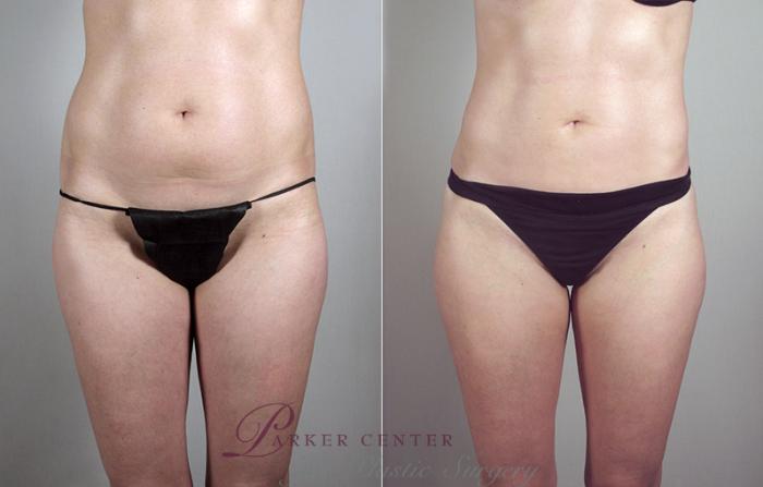 Liposuction Case 793 Before & After View #1 | Paramus, NJ | Parker Center for Plastic Surgery