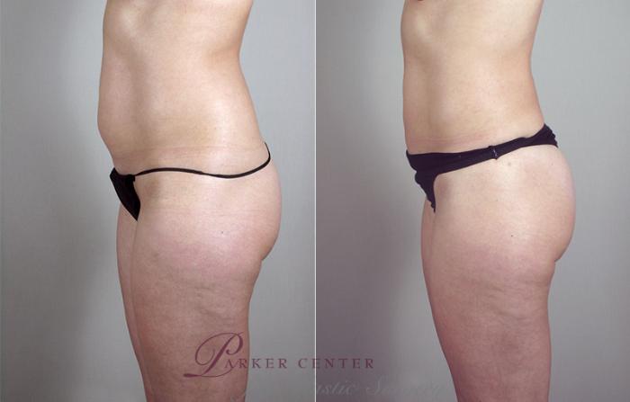 Liposuction Case 793 Before & After View #2 | Paramus, NJ | Parker Center for Plastic Surgery