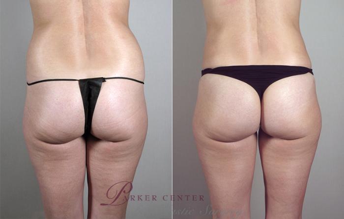 Liposuction Case 793 Before & After View #3 | Paramus, NJ | Parker Center for Plastic Surgery