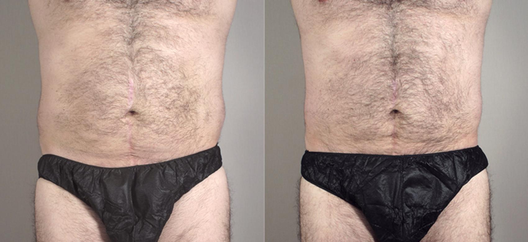 Liposuction Case 794 Before & After View #1 | Paramus, NJ | Parker Center for Plastic Surgery