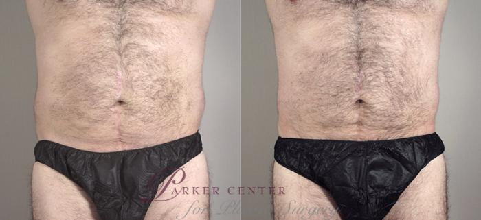 Liposuction Case 794 Before & After View #1 | Paramus, NJ | Parker Center for Plastic Surgery