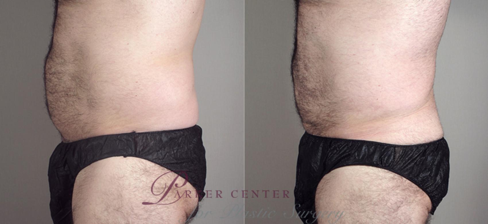 Liposuction Case 794 Before & After View #2 | Paramus, NJ | Parker Center for Plastic Surgery