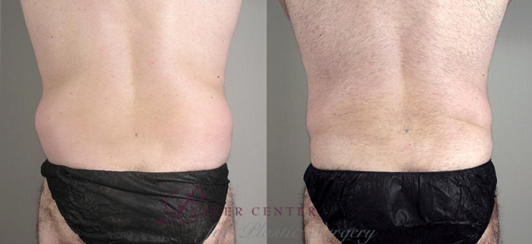 Liposuction Case 794 Before & After View #3 | Paramus, NJ | Parker Center for Plastic Surgery