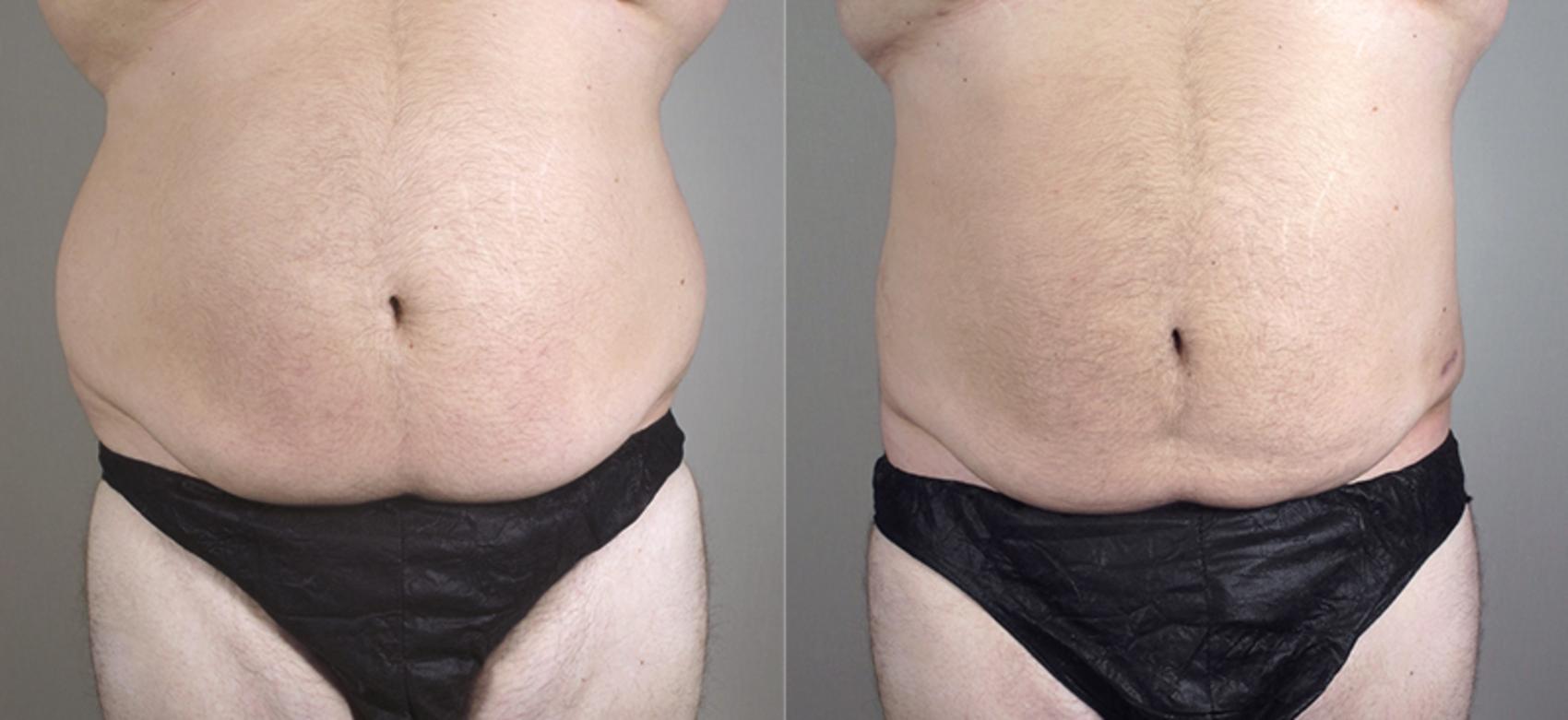 Liposuction Case 795 Before & After View #1 | Paramus, NJ | Parker Center for Plastic Surgery