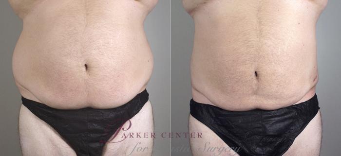 Liposuction Case 795 Before & After View #1 | Paramus, NJ | Parker Center for Plastic Surgery